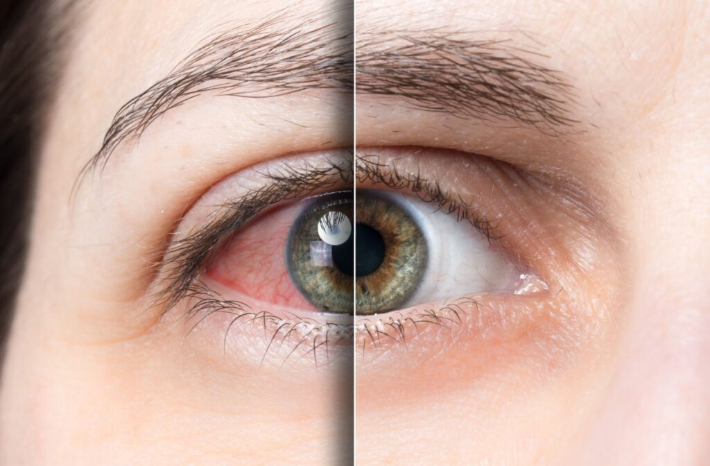 IPL—A New Option for The Treatment of Dry Eyes
