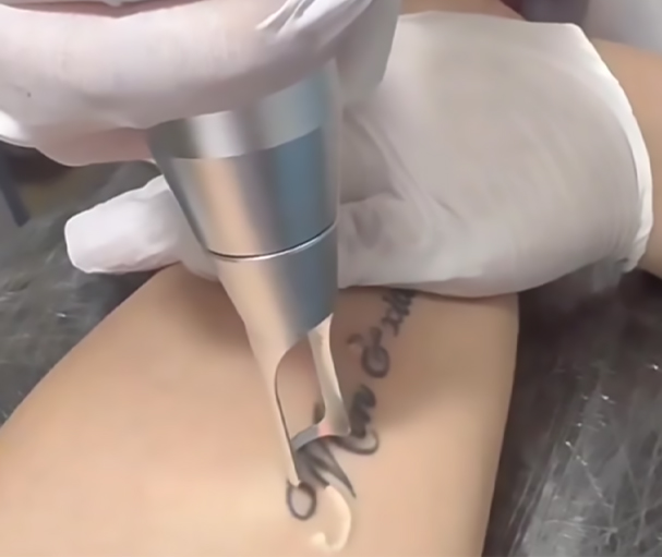 What Is Neodymium YAG Laser