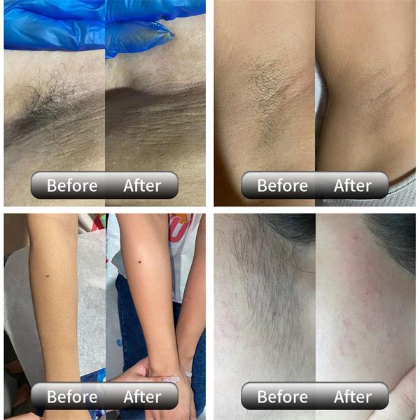 Alexandrite Laser Hair Removal Technology Principle And Clinical Advantages
