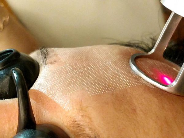 Questions And Answers about CO2 Fractional Laser