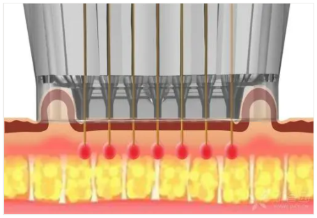 RF microneedle